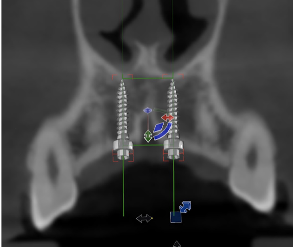 szkolenie in-office pozycjonowanie mikroimplantow
