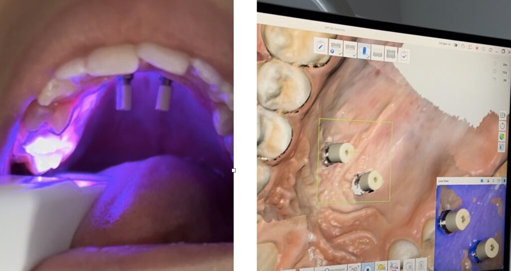 Szkolenie in office systemy aparatów podniebiennych scanbody
