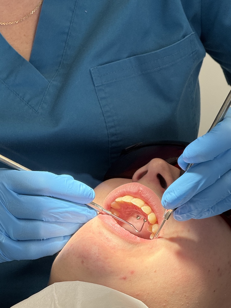 Szkolenie in-office Systemy Aparatów podniebiennych zabieg na żywo